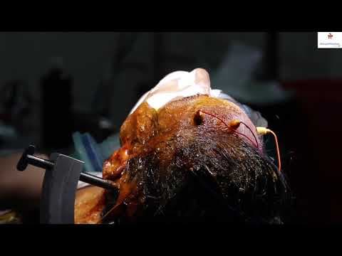 Brain Surgery Hospital in Bangalore | Dr. Bopanna - Manipal Hospitals