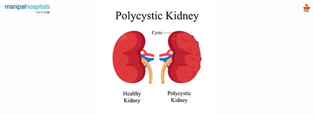 polycystic kidney disease symptoms
