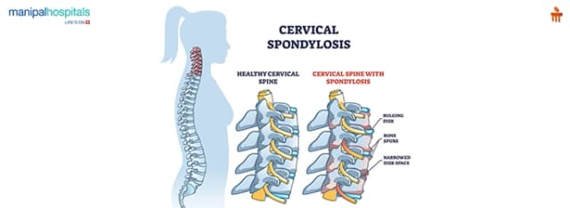 cervical spondylosis