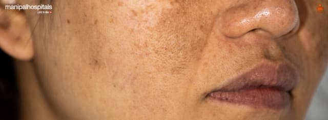 reduce hyperpigmentation skin