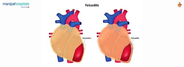 pericarditis symptoms