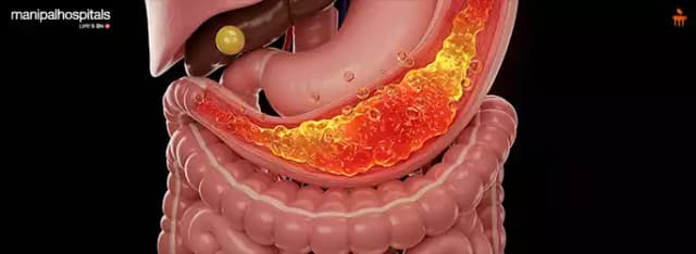 Understanding Acid Reflux: Causes, Symptoms and Advanced Treatment