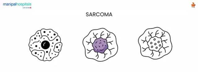 Soft tissue sarcoma